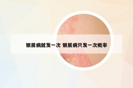银屑病就发一次 银屑病只发一次概率