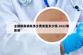 全国银屑病有多少费用是多少钱 2021银屑病