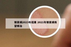 银屑病2023年结果 2021年银屑病有望根治