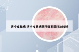 济宁皮肤病 济宁皮肤病医院哪家医院比较好