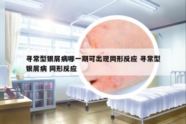 寻常型银屑病哪一期可出现同形反应 寻常型银屑病 同形反应