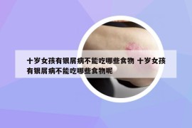 十岁女孩有银屑病不能吃哪些食物 十岁女孩有银屑病不能吃哪些食物呢