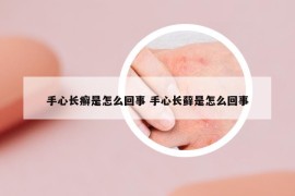 手心长癣是怎么回事 手心长藓是怎么回事