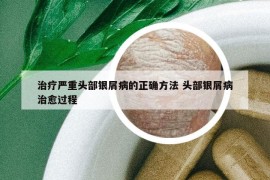 治疗严重头部银屑病的正确方法 头部银屑病治愈过程