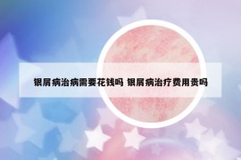银屑病治病需要花钱吗 银屑病治疗费用贵吗