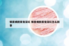 银屑病脱屑变深红 银屑病脱屑变深红怎么回事