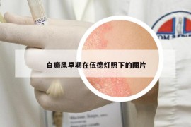 白癜风早期在伍德灯照下的图片