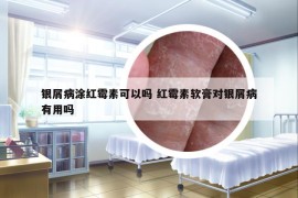 银屑病涂红霉素可以吗 红霉素软膏对银屑病有用吗