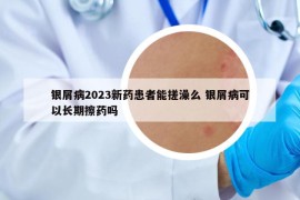 银屑病2023新药患者能搓澡么 银屑病可以长期擦药吗