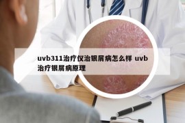 uvb311治疗仪治银屑病怎么样 uvb治疗银屑病原理