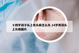 十四岁孩子头上有头癣怎么办 14岁男孩头上长癣图片