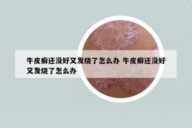牛皮癣还没好又发烧了怎么办 牛皮癣还没好又发烧了怎么办