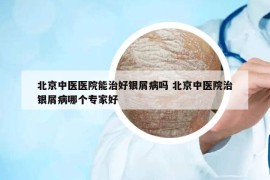 北京中医医院能治好银屑病吗 北京中医院治银屑病哪个专家好