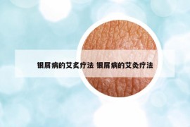 银屑病的艾炙疗法 银屑病的艾灸疗法
