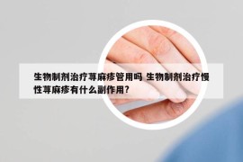 生物制剂治疗荨麻疹管用吗 生物制剂治疗慢性荨麻疹有什么副作用?
