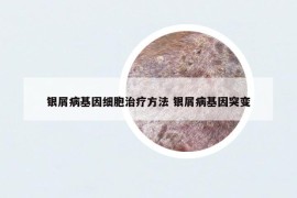 银屑病基因细胞治疗方法 银屑病基因突变