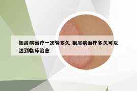 银屑病治疗一次管多久 银屑病治疗多久可以达到临床治愈