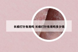 长癣打针有用吗 长癣打针有用吗多少钱