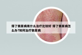 得了银屑病用什么治疗比较好 得了银屑病怎么办?如何治疗银屑病