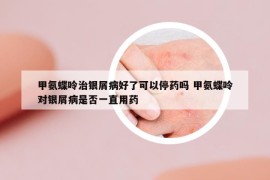 甲氨蝶呤治银屑病好了可以停药吗 甲氨蝶呤对银屑病是否一直用药