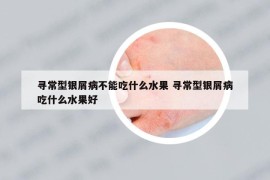 寻常型银屑病不能吃什么水果 寻常型银屑病吃什么水果好