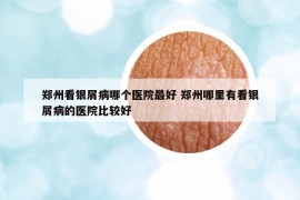 郑州看银屑病哪个医院最好 郑州哪里有看银屑病的医院比较好