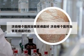 济南哪个医院治银屑病最好 济南哪个医院治银屑病最好的