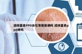 结核菌素PPD会引发银屑病吗 结核菌素ppd疼吗