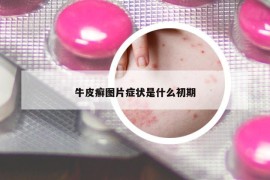 牛皮癣图片症状是什么初期