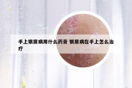 手上银屑病用什么药膏 银屑病在手上怎么治疗