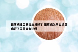 银屑病性关节炎皮损好了 银屑病关节炎银屑病好了关节炎会犯吗