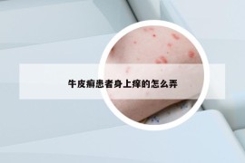 牛皮癣患者身上痒的怎么弄