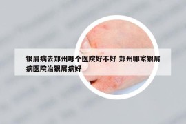 银屑病去郑州哪个医院好不好 郑州哪家银屑病医院治银屑病好