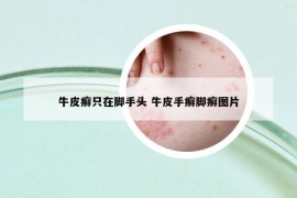 牛皮癣只在脚手头 牛皮手癣脚癣图片