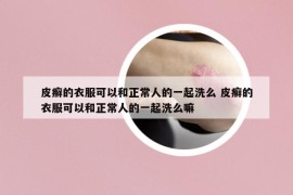 皮癣的衣服可以和正常人的一起洗么 皮癣的衣服可以和正常人的一起洗么嘛