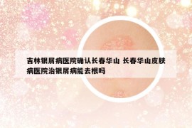 吉林银屑病医院确认长春华山 长春华山皮肤病医院治银屑病能去根吗