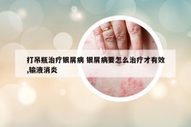 打吊瓶治疗银屑病 银屑病要怎么治疗才有效,输液消炎