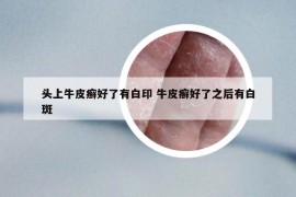 头上牛皮癣好了有白印 牛皮癣好了之后有白斑
