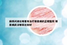 麻烦问湖北哪里有治疗银屑病的正规医院 银屑病武汉哪家比较好