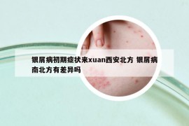 银屑病初期症状来xuan西安北方 银屑病南北方有差异吗