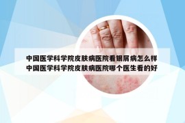 中国医学科学院皮肤病医院看银屑病怎么样 中国医学科学院皮肤病医院哪个医生看的好