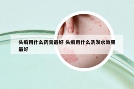 头癣用什么药膏最好 头癣用什么洗发水效果最好