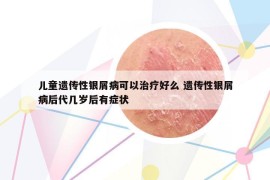 儿童遗传性银屑病可以治疗好么 遗传性银屑病后代几岁后有症状
