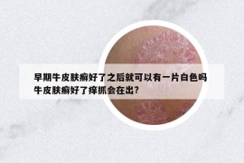 早期牛皮肤癣好了之后就可以有一片白色吗 牛皮肤癣好了痒抓会在出?