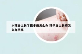 小孩身上长了很多癣怎么办 孩子身上长癣怎么办回事