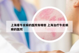 上海看牛皮癣的医院有哪些 上海治疗牛皮病癣的医院