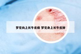 梦见向上长牛皮癣 梦见身上长牛皮鲜