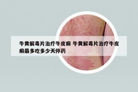 牛黄解毒片治疗牛皮癣 牛黄解毒片治疗牛皮癣最多吃多少天停药