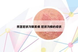阴茎冠状沟银屑病 冠状沟癣的症状