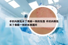 手肘内侧处长了像癣一样的东西 手肘内侧处长了像癣一样的东西图片